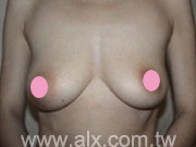 乳房下垂