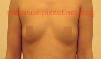 breast a.jpg