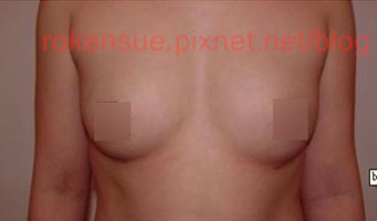 breast a1.jpg