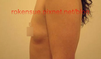 breast a2.jpg