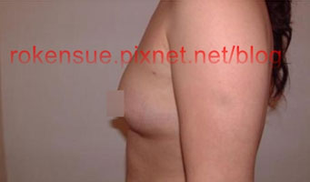 breast a3.jpg