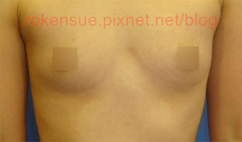 breast a8.jpg