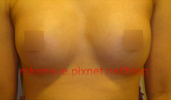 breast a9.jpg
