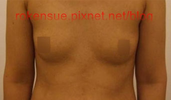 breasta4.jpg
