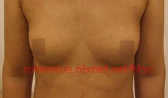 breasta5.jpg