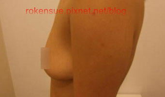 breast a6.jpg