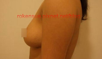 breast a7.jpg