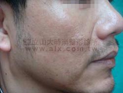 柔膚雷射後