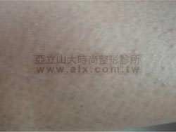柔膚雷射前