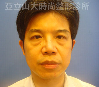 眼袋手術