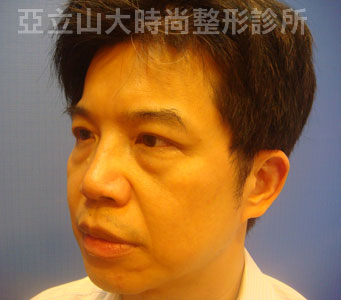 眼袋手術