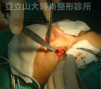 眼袋手術