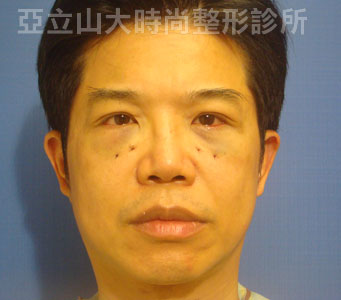 眼袋手術