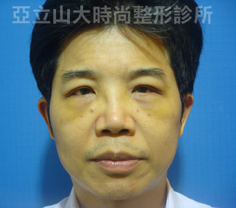 眼袋手術