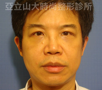 眼袋手術