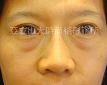 傳統的眼袋手術