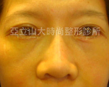 傳統的眼袋手術