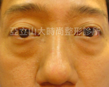 傳統的眼袋手術
