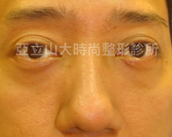 傳統的眼袋手術