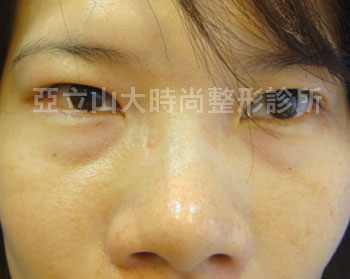 眼袋手術
