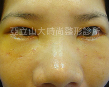 眼袋手術