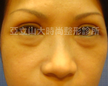眼袋手術