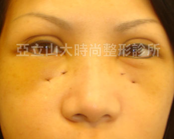 眼袋手術