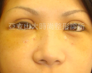 眼袋手術