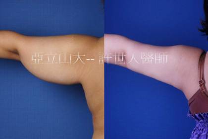 手臂環抽