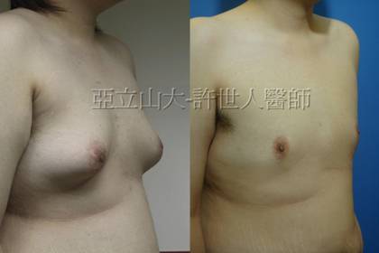 男性女乳症