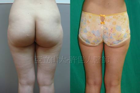 臀部和大腿