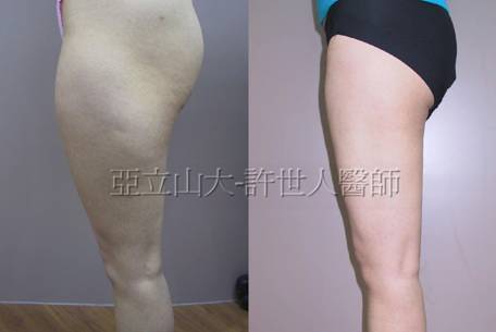 臀部和大腿