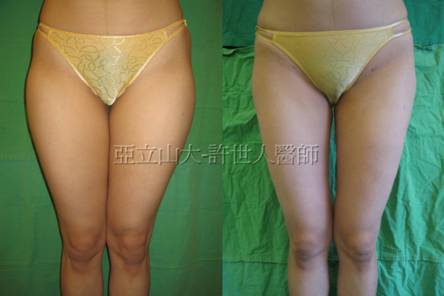 臀部和大腿