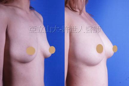 自體脂肪隆乳