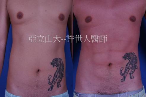 六塊肌整形