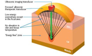 Wi׾ULTRASHAPE