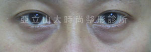 眼袋手術
