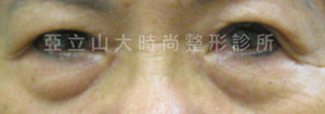 眼袋手術