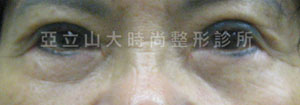 眼袋手術