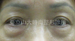 眼袋手術