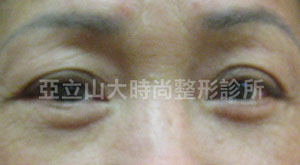 眼袋手術
