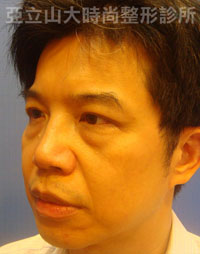 眼袋手術