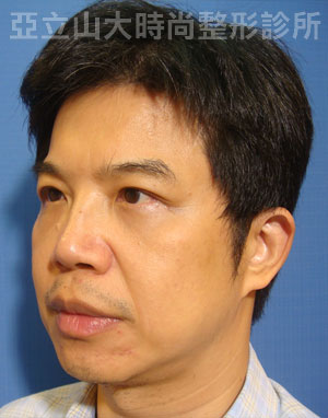 眼袋手術