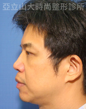 眼袋手術