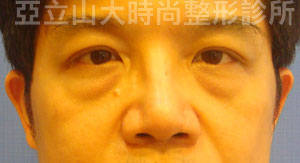 眼袋手術