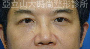 眼袋手術