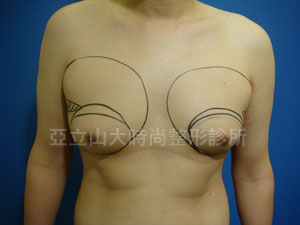 男性女乳手術
