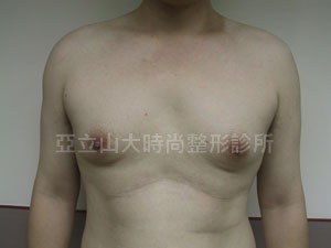 男性女乳手術