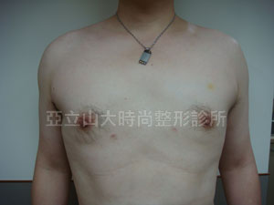 男性女乳手術