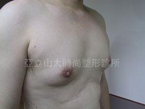 男性女乳手術
